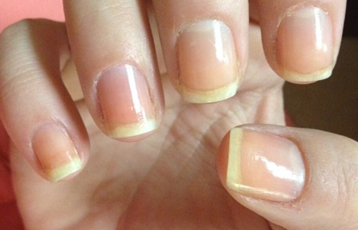 Yellow Nails: Causes, Treatment and Prevention