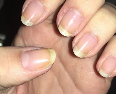Startling Reasons Why Your Nails Turn Yellow