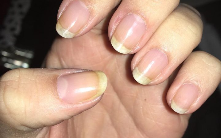 Startling Reasons Why Your Nails Turn Yellow