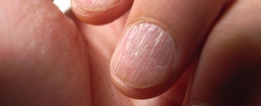 nail ridges