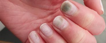 What Are Green Fungus Under Acrylic Nail?