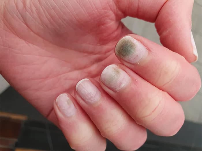 Picture of Acrylic Nail Fungus 