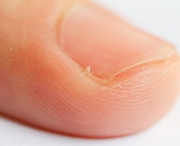 how to treat an infected hangnail