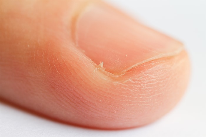 how to treat an infected hangnail