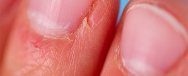 are hangnails a sign of vitamin deficiency