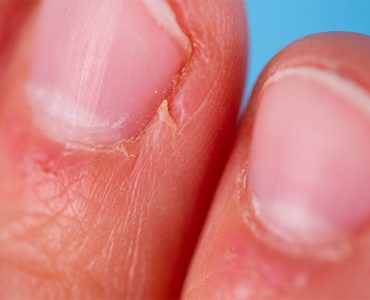 are hangnails a sign of vitamin deficiency