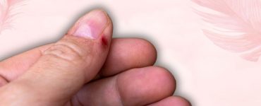 How to Heal and Soothe an Infected Hangnail