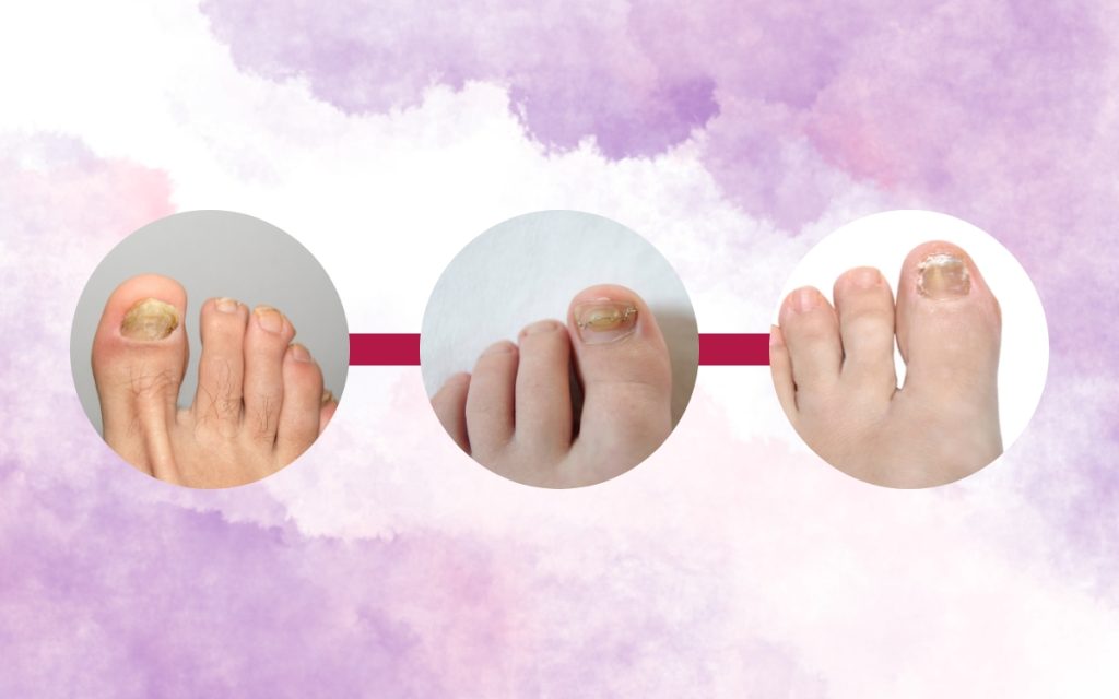 Understanding the Different Stages of Ingrown Nails Polish and Pearls