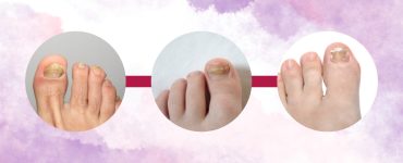 Understanding the Different Stages of Ingrown Nails