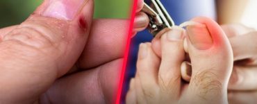 Hangnails vs. Ingrown Nails: What's the Real Difference?
