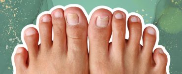 Link Between Nail Fungus and Other Health Conditions