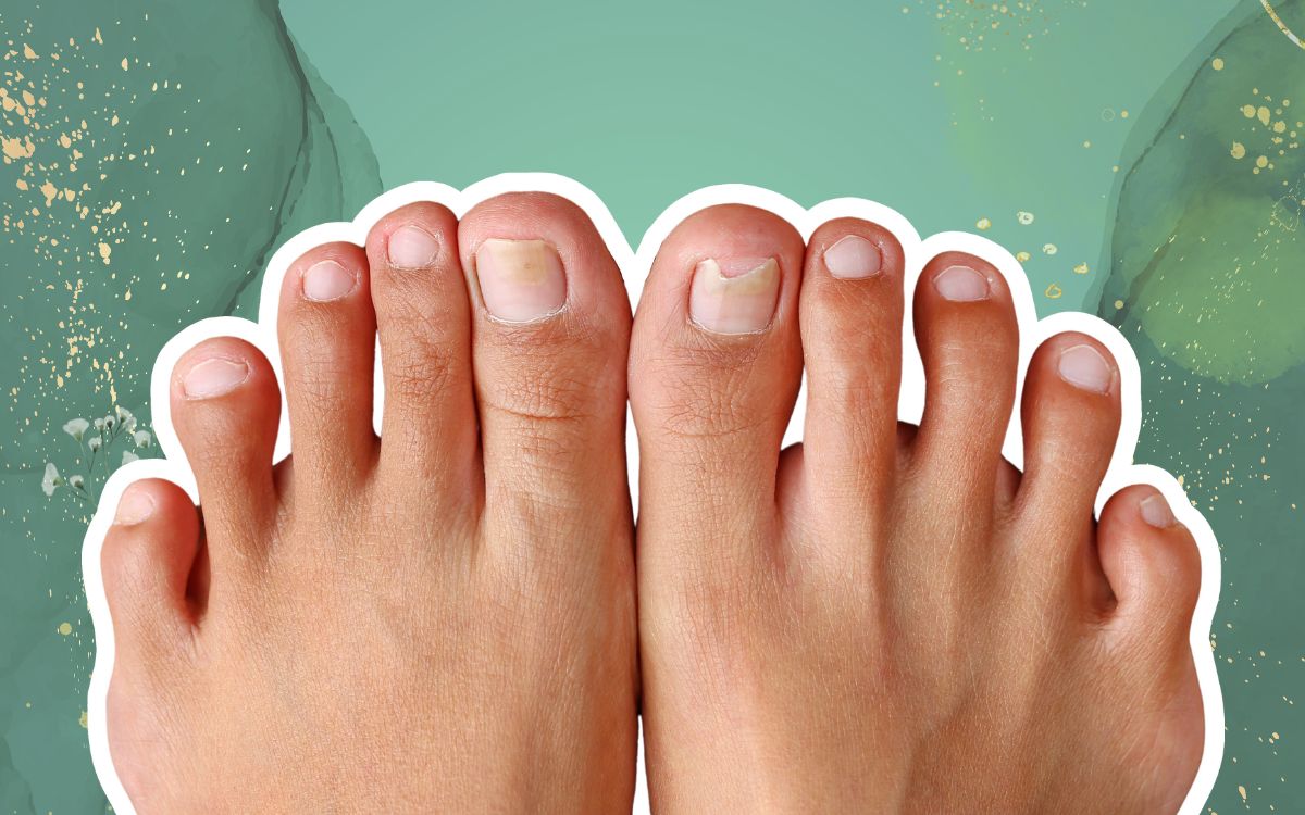 Link Between Nail Fungus and Other Health Conditions