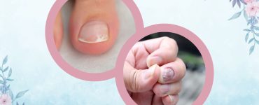 Spotting the Signs of Nail Fungus