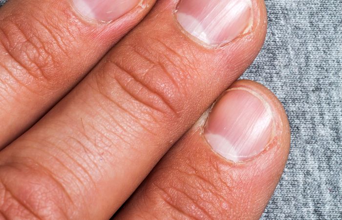close up of bad condition nails